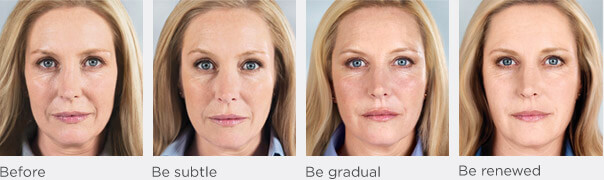 sculptra-1 sculptra-1
