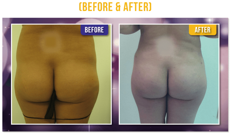 Brazilian Butt Lift Before & After Brazilian Butt Lift Before & After