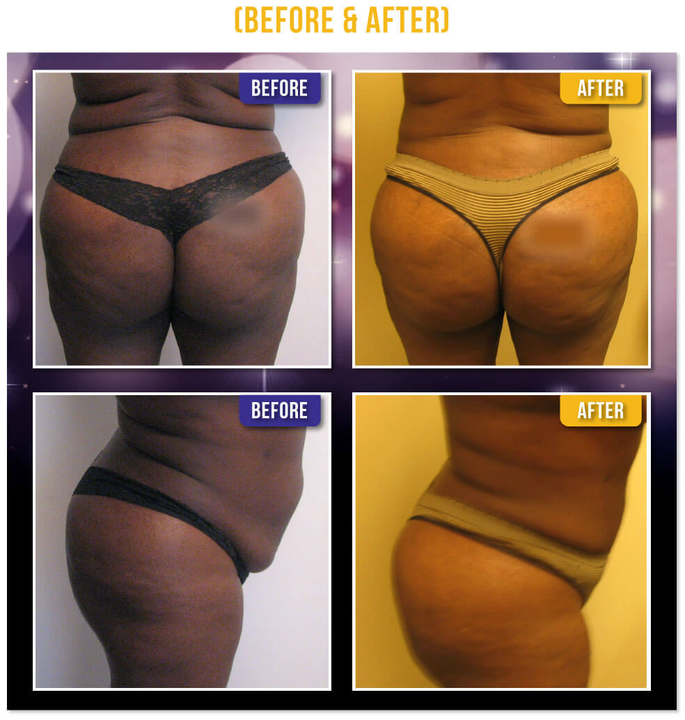 Brazilian Butt Lift Before & After Brazilian Butt Lift Before & After