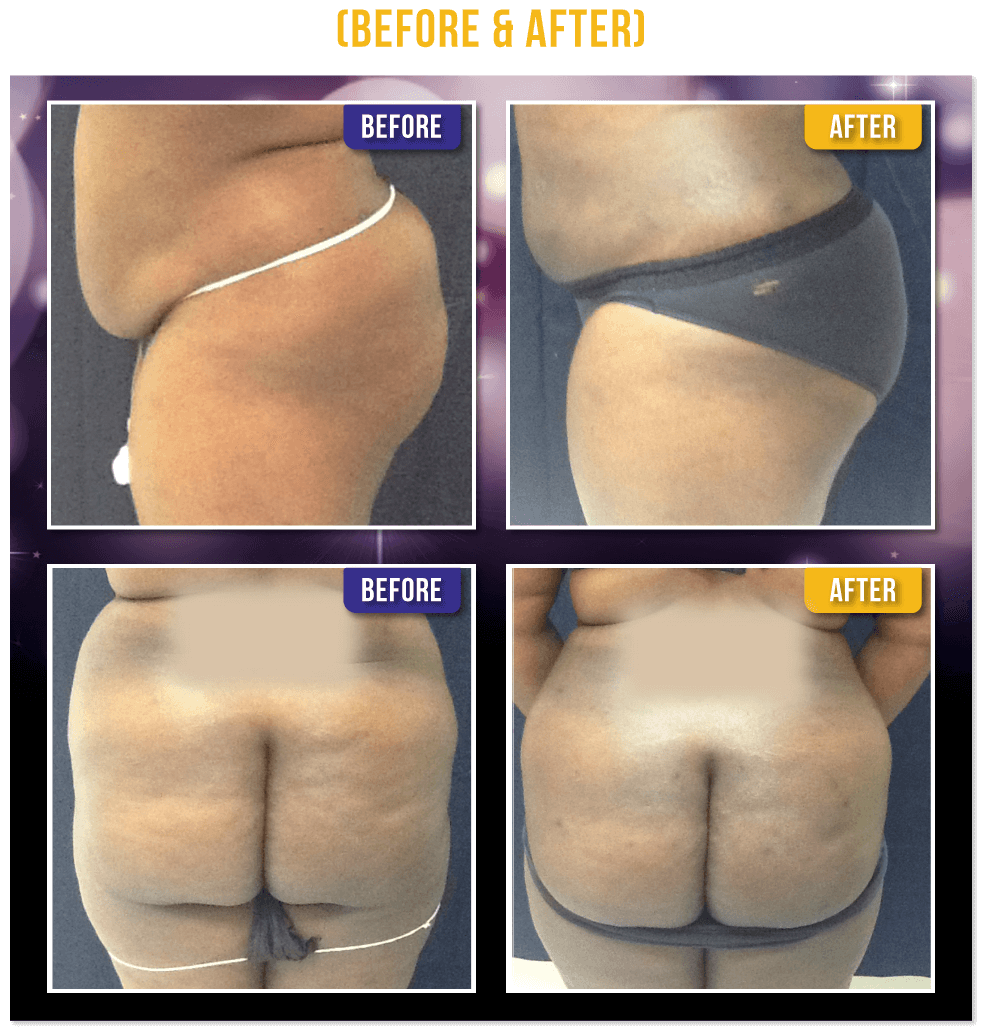 Brazilian Butt Lift Before & After Brazilian Butt Lift Before & After