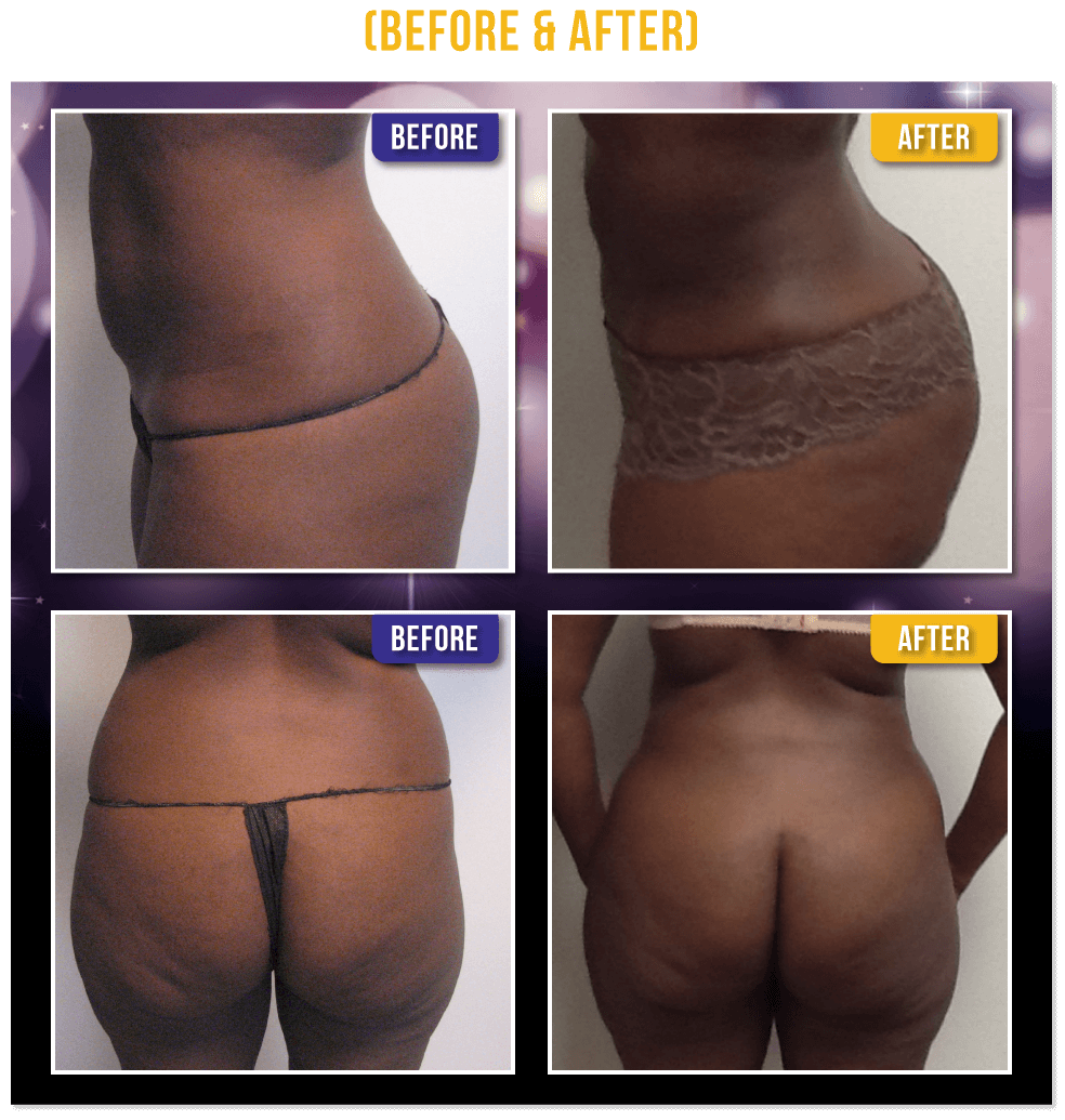 Brazilian Butt Lift Before & After Brazilian Butt Lift Before & After