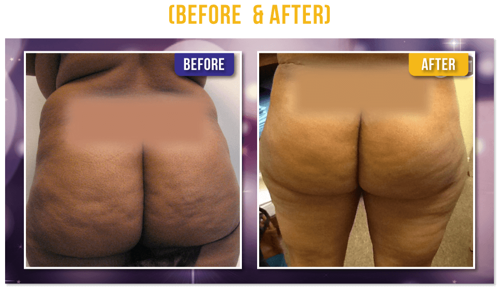 Brazilian Butt Lift Before & After Brazilian Butt Lift Before & After