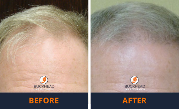 Before-and-After-1,500-Grafts Male Hair Loss Solutions are here! 