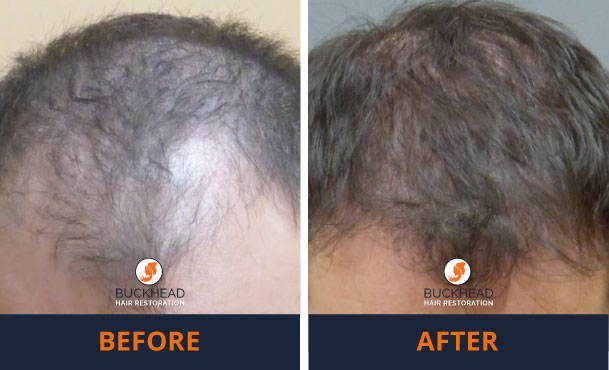 Before and After 2,500 Grafts Male Hair Loss 