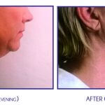 Pure Lipo Chin Liposuction Atlanta