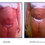 Pure Lipo Atlanta