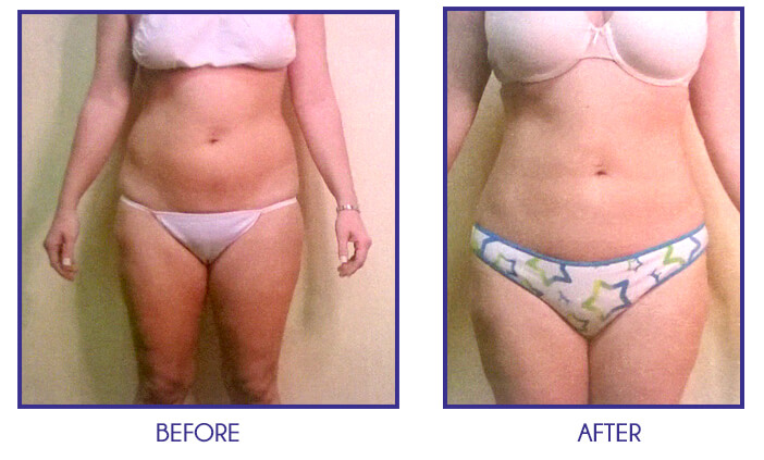 Liposuction of abdomen, back, and flanks before and after 6 weeks Liposuction of abdomen, back, and flanks