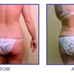 Liposuction of abdomen, back and flanks before and after 3 months* Results are not guaranteed and vary from patient to patient