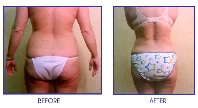 Liposuction of abdomen, back, and flanks before and after 6 weeks Liposuction of abdomen, back, and flanks before and after 6 weeks