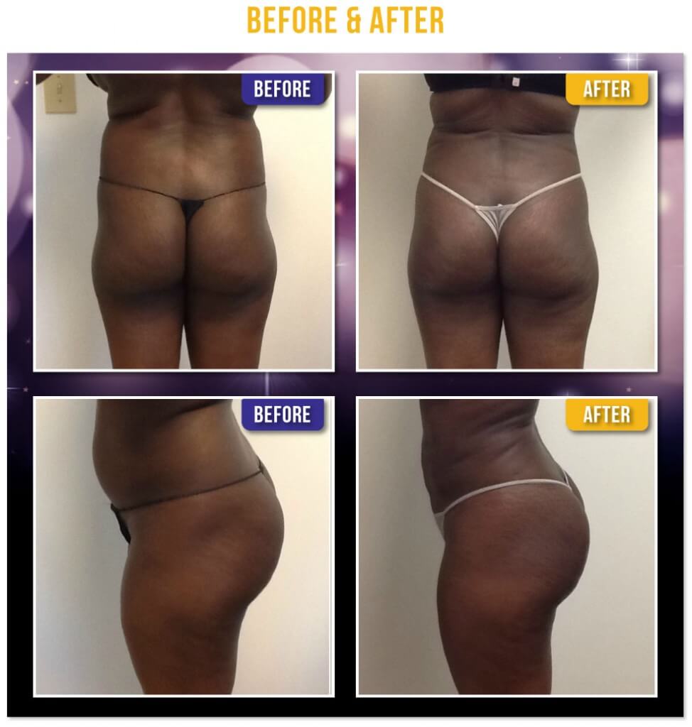 Liposuction of the abdomen, flanks, and back. Before and after Fat Transfer to the Buttocks - Brazilian Butt Lift