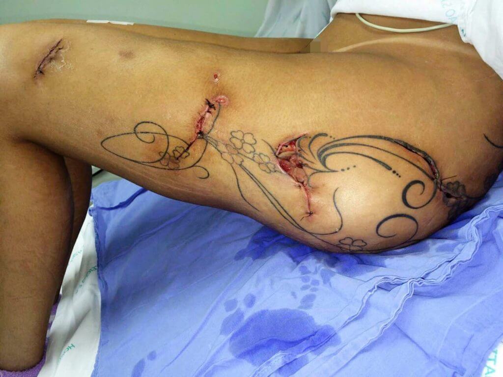 Brazilian Butt Lift Butt surgery gone wrong 