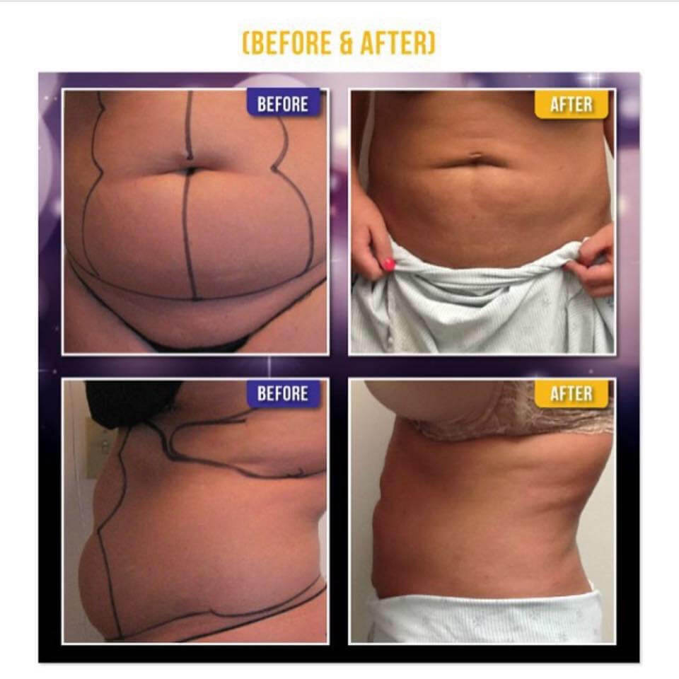 great liposuction results