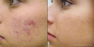 Vivace Micro-Needling RF for active Acne and to reduce scars