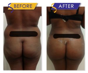 Brazilian Butt Lift via Liposuction with Fat Transfer by Dr. Monte Slater