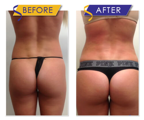 Brazilian Butt Lift via Liposuction with Fat Transfer by Dr. Monte Slater