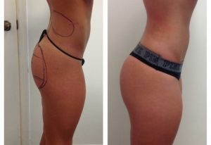 Sculptra Butt lift and Lipo Suction results