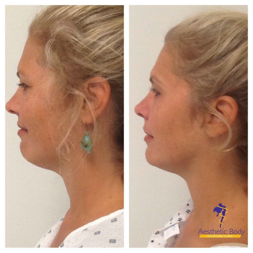 VivaceRF Micro-Needling Treatment before and 6 weeks after -The goal was to lift and tighten the skin of the face and neck. VivaceRF Micro-Needling before and after 6 weeks.
