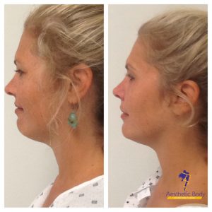 Vivace RF Skin Treatments - Micro-Needling with Radiofrequency before and after 6 weeks.