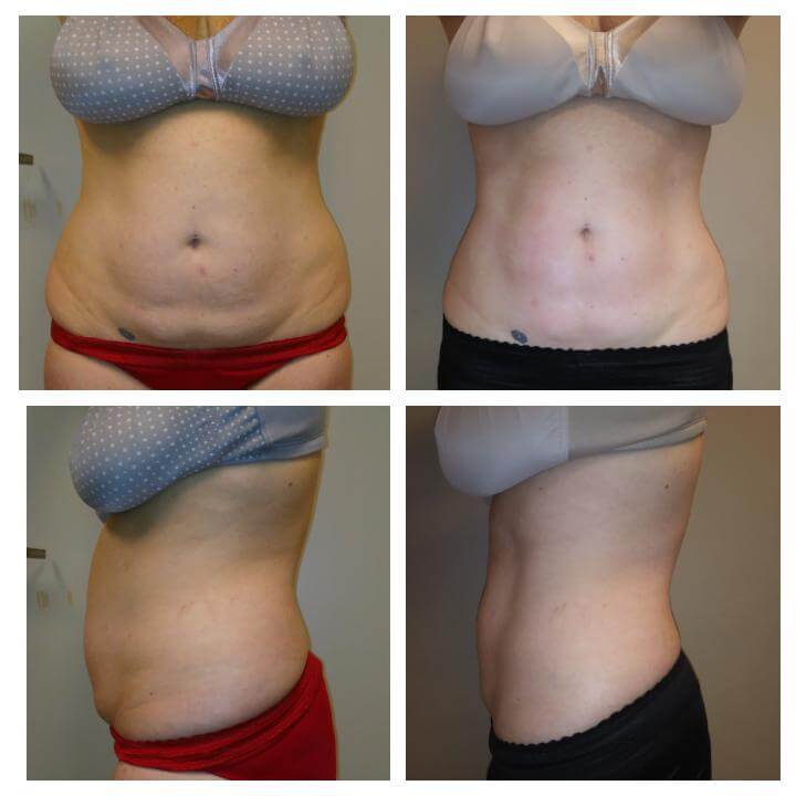 48 year old Before and After 3 treatments with the Ultra Slim Plus II Post Liposuction Care - Treatment Goal - Improve Healing & Prevent Scar Tissue - Copyright 2018 Christina Perez at Aesthetic Body Sculpture Clinic and Center for Anti-Aging 48 year old Before and After 3 treatments with the Ultra Slim Plus II Post Liposuction Care - Treatment Goal - Improve Healing & Prevent Scar Tissue