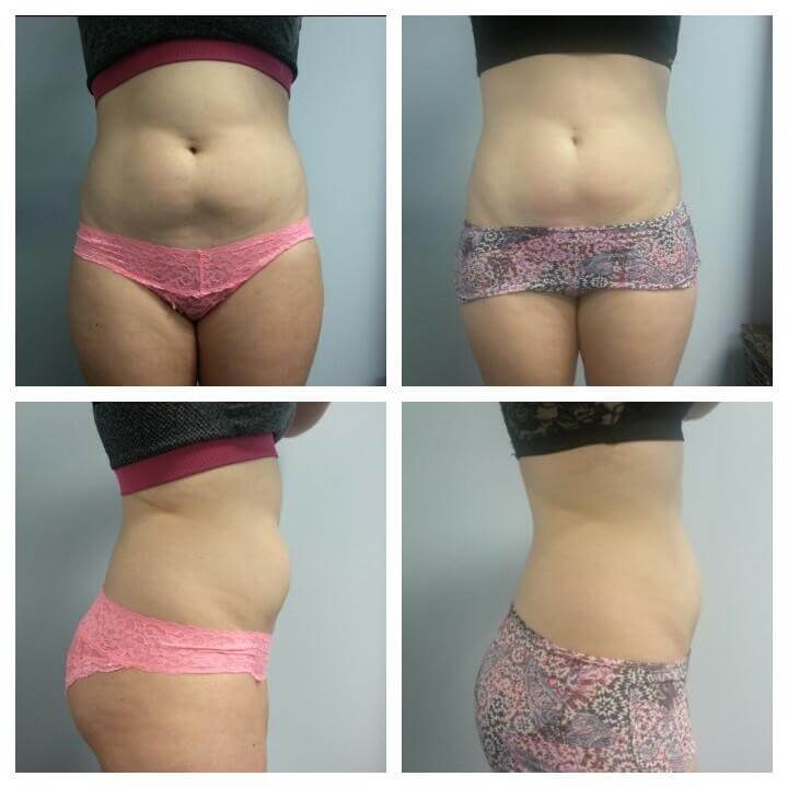 23 Year Old Female - Before and After 3 Treatments - Treatment Goal Fat Reduction and Sculpting - Copyright 2018-2019 Christina Perez - Aesthetic Body Sculpture Clinic and Center for Anti-Aging 23 Year Old Female - Before and After 3 Treatments - Treatment Goal Fat Reduction and Body Sculpting