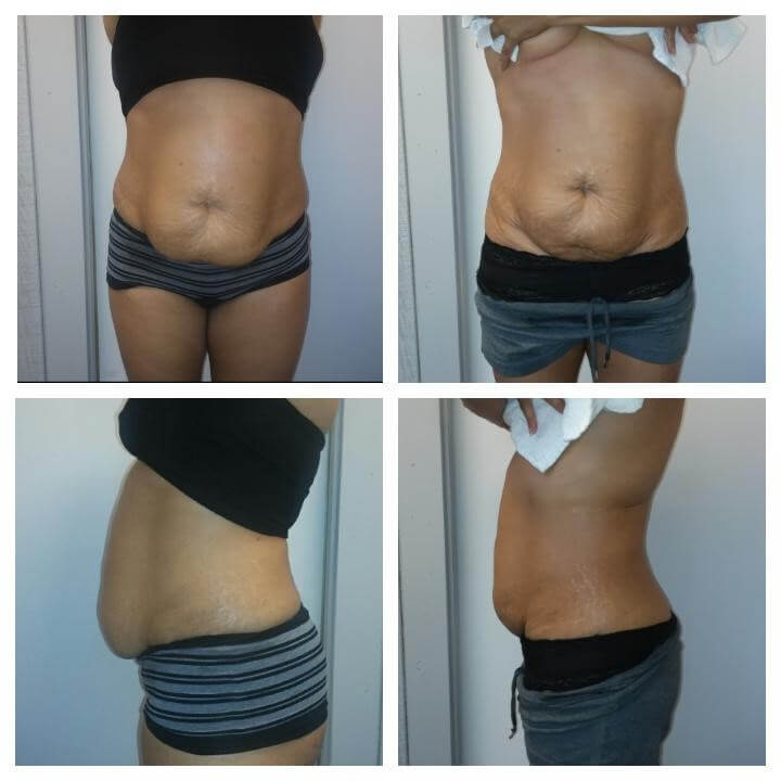 Before and After 4 Treatments - Treatment Goal - Skin Tightening and Fat Reduction Copyright 2018 - Christina Perez Esthetician at Aesthetic Body Sculpture Clinic and Center for Anti-Aging Before and After 4 Body Sculpting Treatments Treatment Goal - Skin Tightening and Fat Reduction