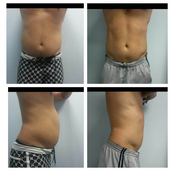 29 Year Old Male - Before and After 4 Body Sculpting Treatments - Treatment Goal - Fat Reduction and Sculpting - Copyright Christina Perez at Aesthetic Body Sculpture Clinic and Center for Anti-Aging 29 Year Old Male - Before and After 4 Treatments with the Ultra Slim II - Treatment Goal - Fat Reduction and Sculpting