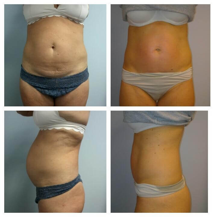 50 Year Old Female - Before and After 4 Treatments with the Ultra Slim Plus II - Treatment Goal - Skin Tightening - Fat Reduction and Sculpting of Abs - Copyright 2018-2019 Christina Perez at Aesthetic Body Sculpture Clinic and Center for Anti-Aging 50 Year Old Female - Before and After 4 Treatments with the Ultra Slim Plus II - Treatment Goal - Skin Tightening - Fat Reduction and Sculpting of Abs