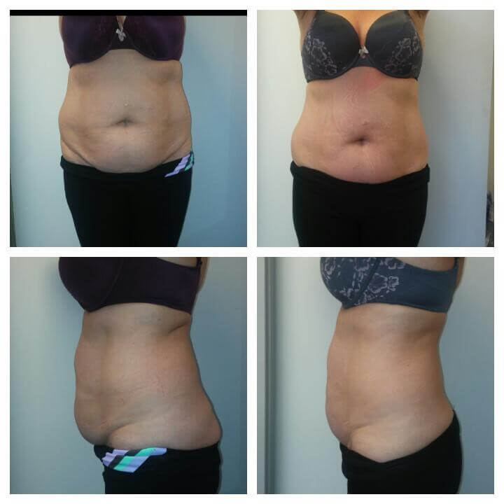 56 Year Old Female Before and After 4 Treatments - Treatment Goal - Skin Tightening and Fat Reduction Copyright 2018 - Christina Perez at Aesthetic Body Sculpture Clinic and Center for Anti-Aging 56 Year Old Female Before and After 4 Treatments with Ultra Slim Plus II - Treatment Goal - Reduction in Skin Laxity and Fat Reduction