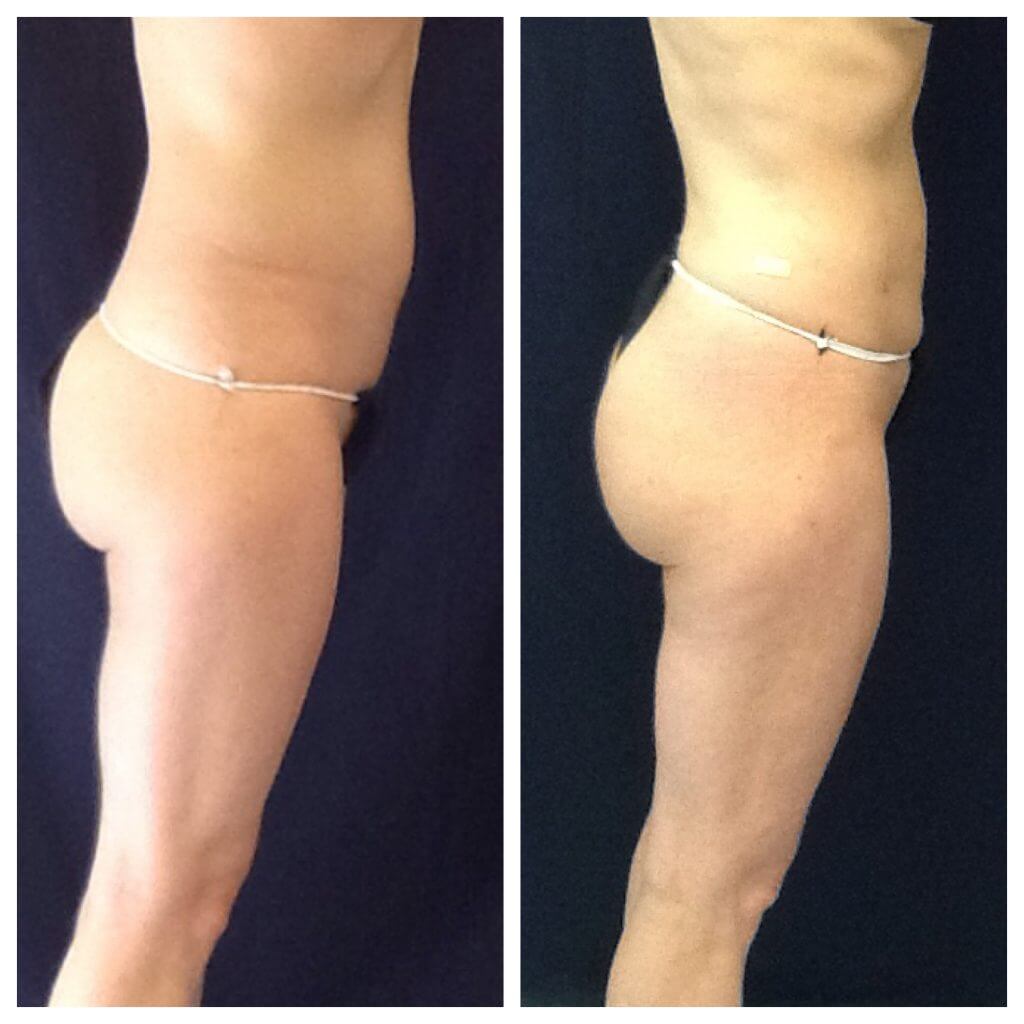 8 Weeks Before and After Liposuction of the abdomen, flanks, lower back, inner thigh. Fat transfer gluteal 350 cc's per side. ThermiTight lower thighs and inner thighs