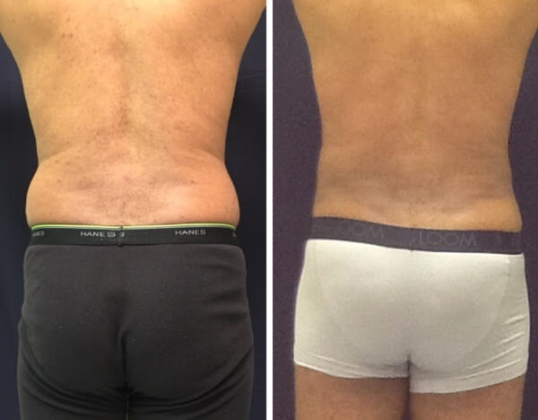 Liposuction of abdomen, flanks and back - before and after 6 weeks Liposuction of abdomen, flanks and back - before and after 6 weeks