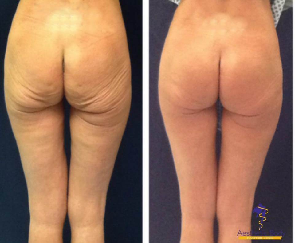 Sculptra Injectable is a safe method to achieve a rounder fuller Butt. Sculptra Butt Lift Before and After slatermd.com