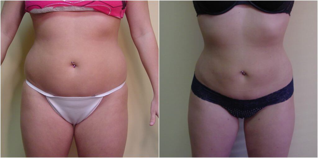 * Real Patient - Before and after liposuction of abdomen, flanks and back