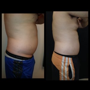 2-body sculpting-treatments-44-inch-waist-to-38-inch-waist-