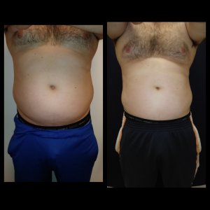 Body Sculpting Treatments - 6 inch reduction with 2 treatments only