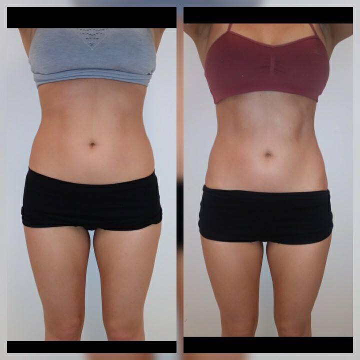 before and after 2 Posh Body Slim Body Contouring Sessions - Treatment Goal Fat Reduction & Skin Tightening