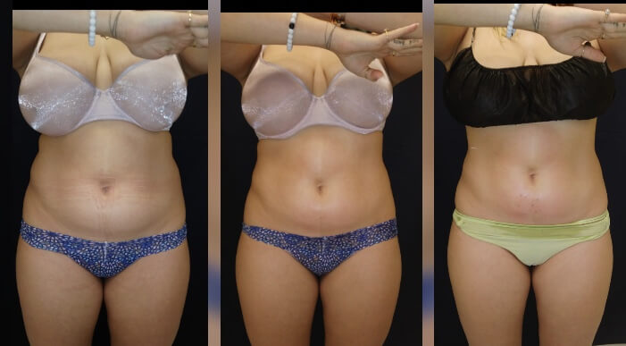 before-and-after-2-body sculpting-treatments-treatment-goal-fat-reduction-skin-tightening Body Sculpting works! 