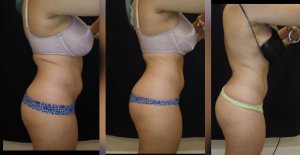 before and after 2-body sculpting-treatments Treatment-goal-fat-reduction-skin-tightening