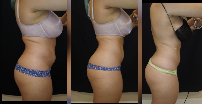 Body Contouring vs Liposuction - Reston Dermatology + Cosmetic Center