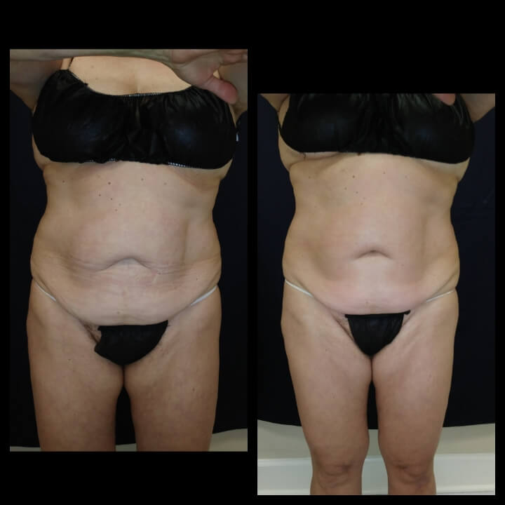 68 year old Before and after 3 Body Sculpting treatments - Treatment Goal - Skin Tightening and Fat Reduction Before and after 3 Body Sculpting treatments - Treatment Goal - Skin Tightening and Fat Reduction
