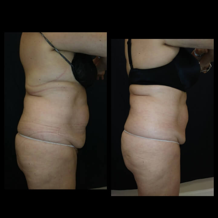 Before and after 3 Body Sculpting treatments - Treatment Goal - Skin Tightening and Fat Reduction Before and after 3 Body Sculpting treatments - Treatment Goal - Skin Tightening and Fat Reduction
