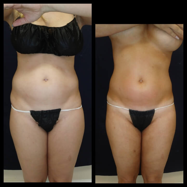 Before and after 3 Ultra Slim Plus II Body Sculpting Treatments - Treatment Goal Fat Reduction and Skin Tightening. Before and after 3 Ultra Slim Plus II Body Sculpting Treatments - Treatment Goal Fat Reduction and Skin Tightening.