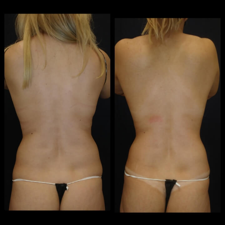 Before and after 3 Posh Body Slim Body Contouring Sessions - Treatment Goal Fat Reduction & Skin Tightening Before and after 3 Posh Body Slim Body Contouring Sessions - Treatment Goal Fat Reduction & Skin Tightening