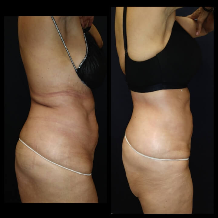 66-year old before and after 2 Posh Body Slim Body Contouring Sessions - Treatment Goal Fat Reduction & Skin Tightening 66-year old before and after 2 Posh Body Slim Body Contouring Sessions - Treatment Goal Fat Reduction & Skin Tightening