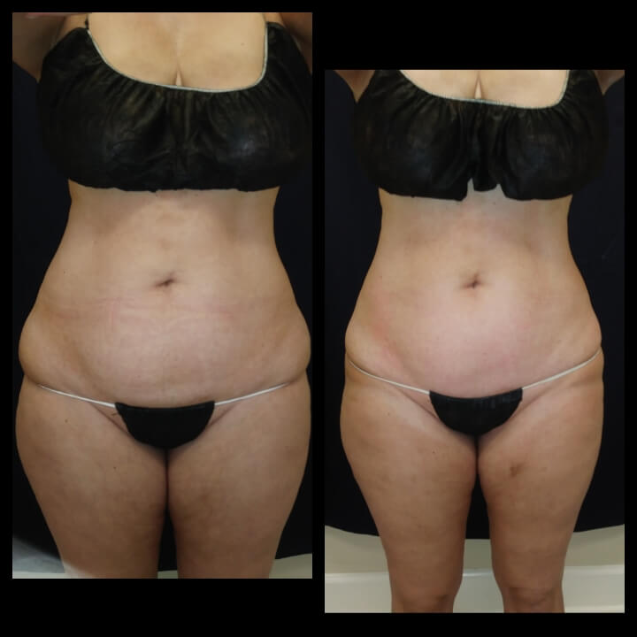 Before and after 3 Posh Body Slim Body Contouring Sessions - Treatment Goal Fat Reduction & Skin Tightening- Before and after 3 Posh Body Slim Body Contouring Sessions - Treatment Goal Fat Reduction & Skin Tightening