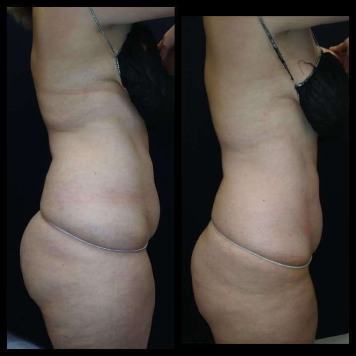 Before and after 3 Posh Body Slim Body Contouring Sessions - Treatment Goal Fat Reduction & Skin Tightening Before and after 3 Posh Body Slim Body Contouring Sessions - Treatment Goal Fat Reduction & Skin Tightening