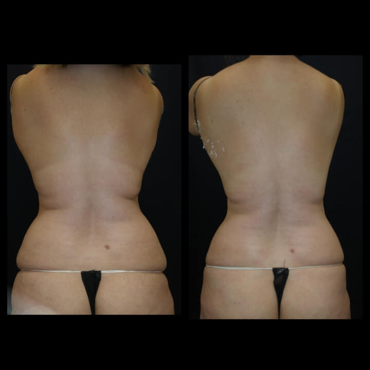 Before and after 3 Posh Body Slim Body Contouring Sessions - Treatment Goal Fat Reduction & Skin Tightening Before and after 3 Posh Body Slim Body Contouring Sessions - Treatment Goal Fat Reduction & Skin Tightening