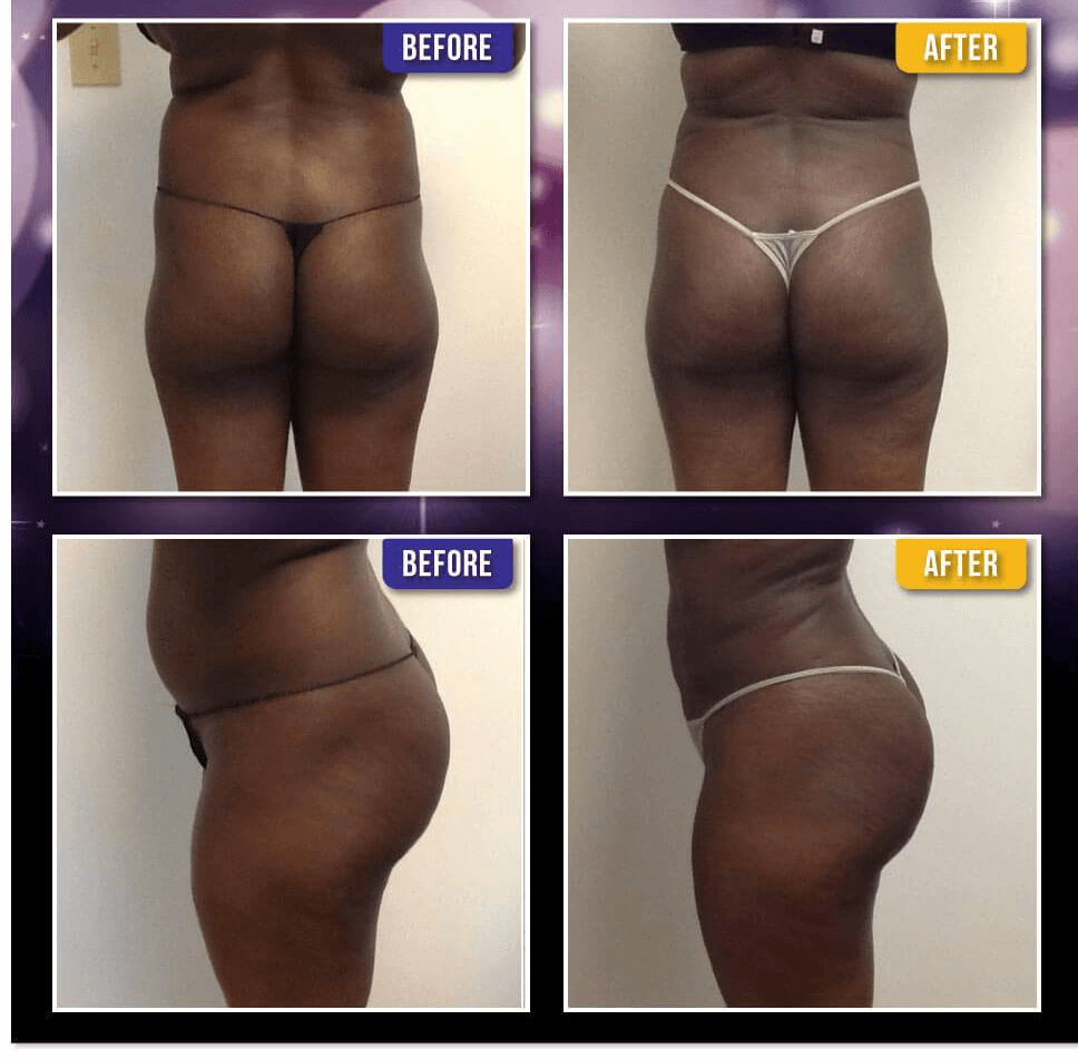 Before and after Brazilian Butt Lift