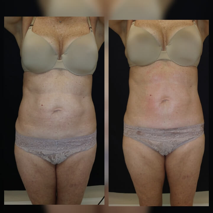 Before and after 2 Posh Body Slim Body Contouring Sessions - Treatment Goal Fat Reduction &