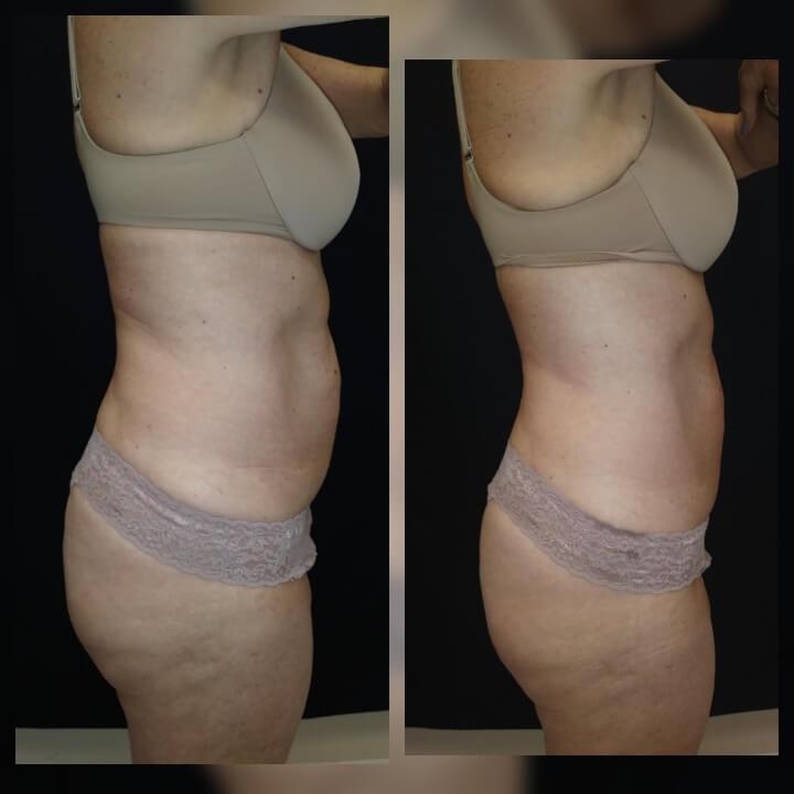 Before and after 2 Posh Body Slim Body Contouring Sessions - Treatment Goal Fat Reduction & Skin Tightening