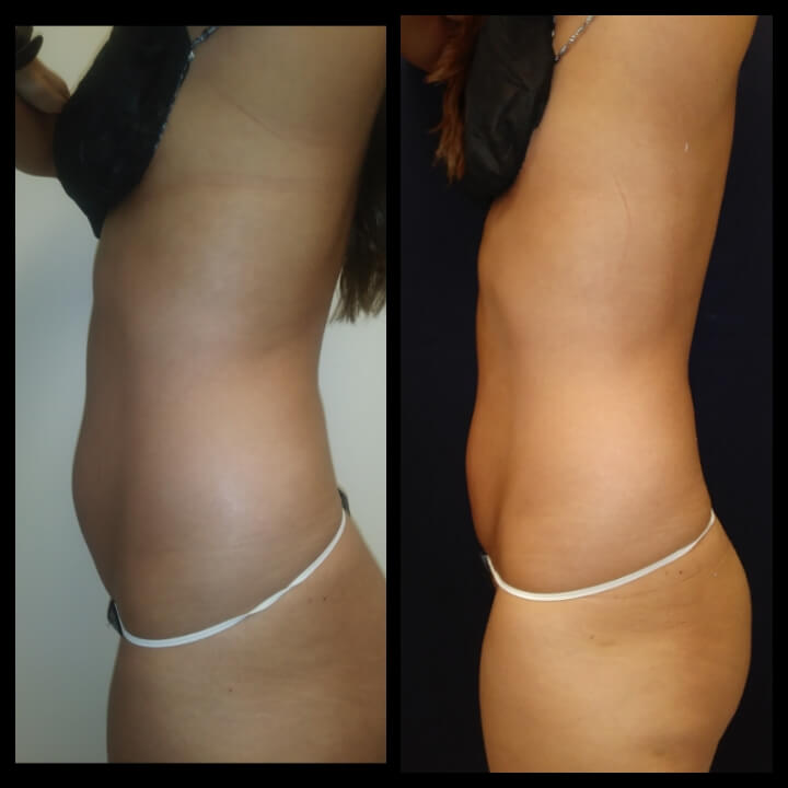 Before and after 2 Posh Body Slim Body Contouring Sessions - Treatment Goal Fat Reduction & Skin Tightening